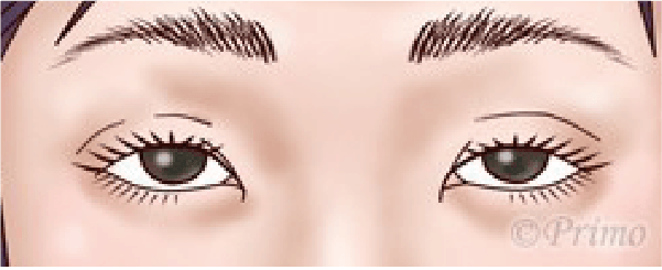 眼瞼下垂の症状